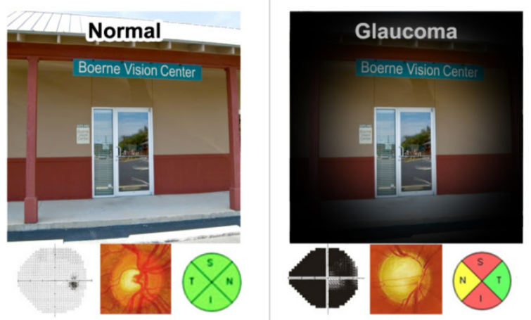 Glaucoma Boerne Vision Center Glaucoma