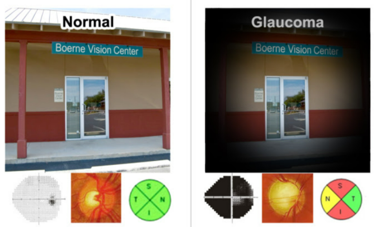 Glaucoma