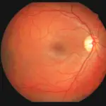 Color fundus photograph of the retina showing the optic disc on the right, arterial/venous vessels radiating outward, and a slightly blurred macular area.